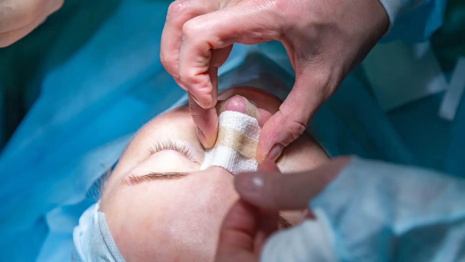 cirujano plasrico de asisa acabando una rinoplastia de una paciente cirujano plasrico de asisa acabando una rinoplastia de una paciente