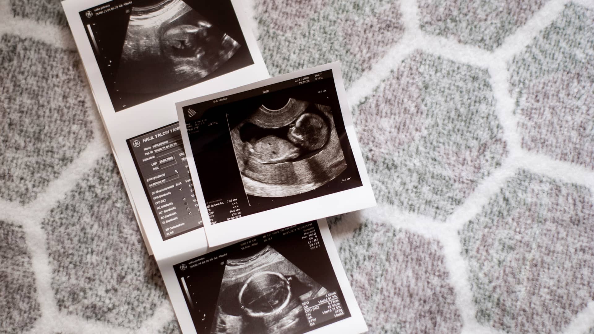 Fotos de una ecografía de un bebé cuya madre se ha sometido a una inseminación artificial con un médico endocrinólogo reproductivo del cuadro médico de Mapfre Fotos de una ecografía de un bebé cuya madre se ha sometido a una inseminación artificial con un médico endocrinólogo reproductivo del cuadro médico de Mapfre