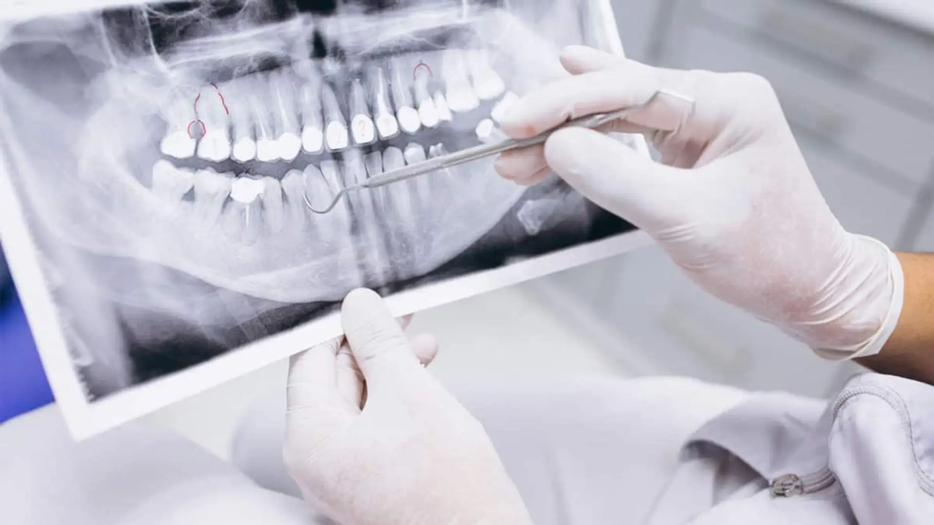 Radiografía dental sostenida por manos con guantes y señalada con un instrumental odontológico